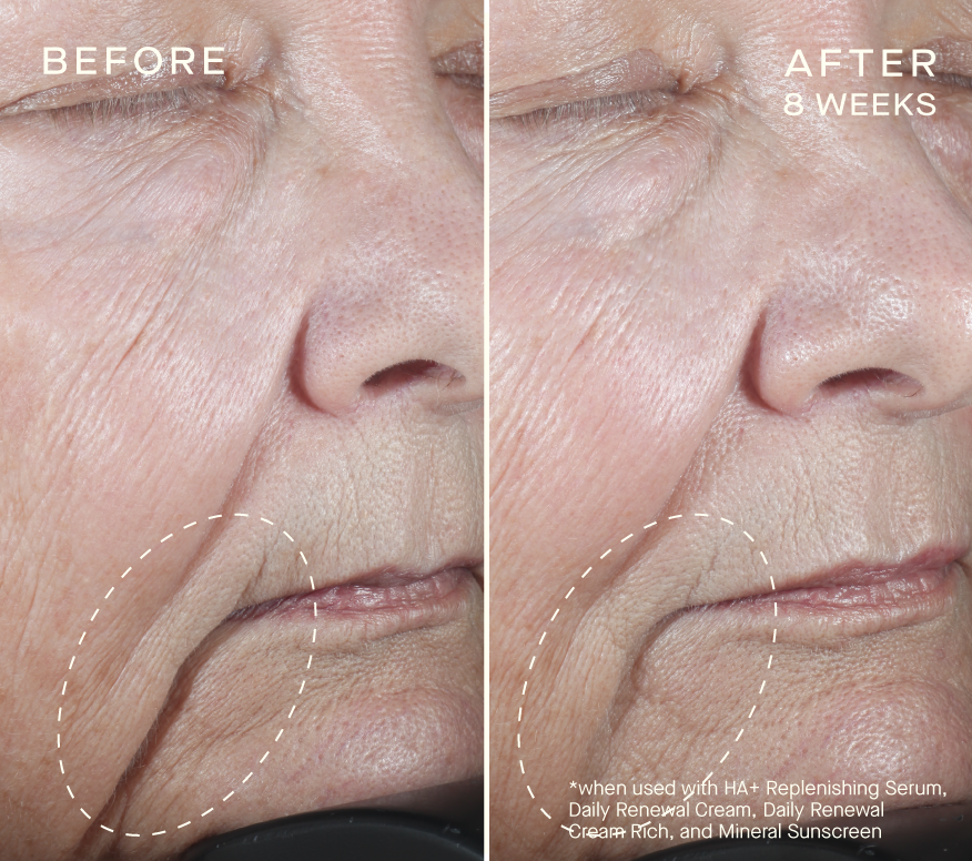 HA+ Firming Boost — The Botox Lady